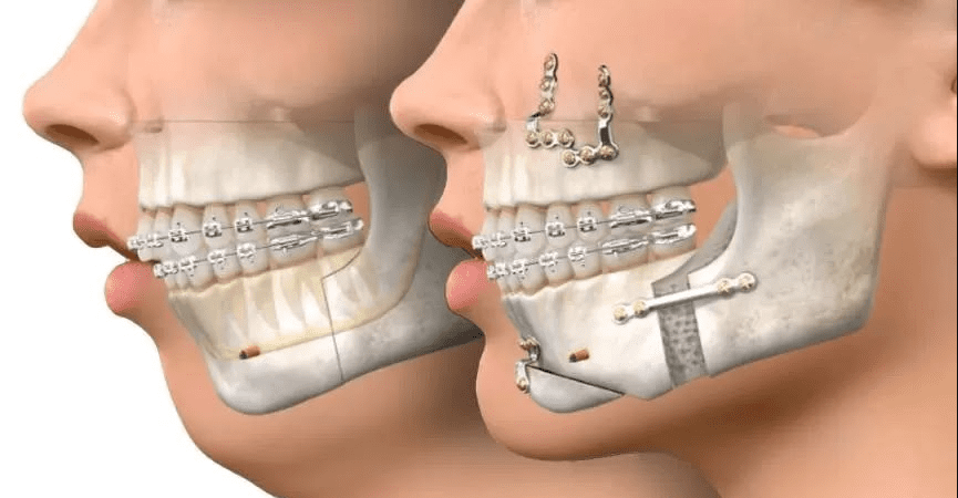 Cirurgia Ortognática: o que é, quando é indicada e se o plano de saúde cobre